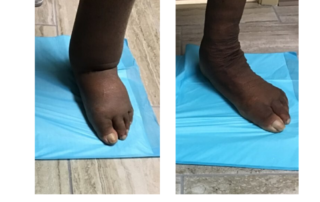 Before and After Lymphedema Treatment