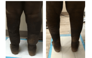 Lymphedema Therapy Specialists before and after