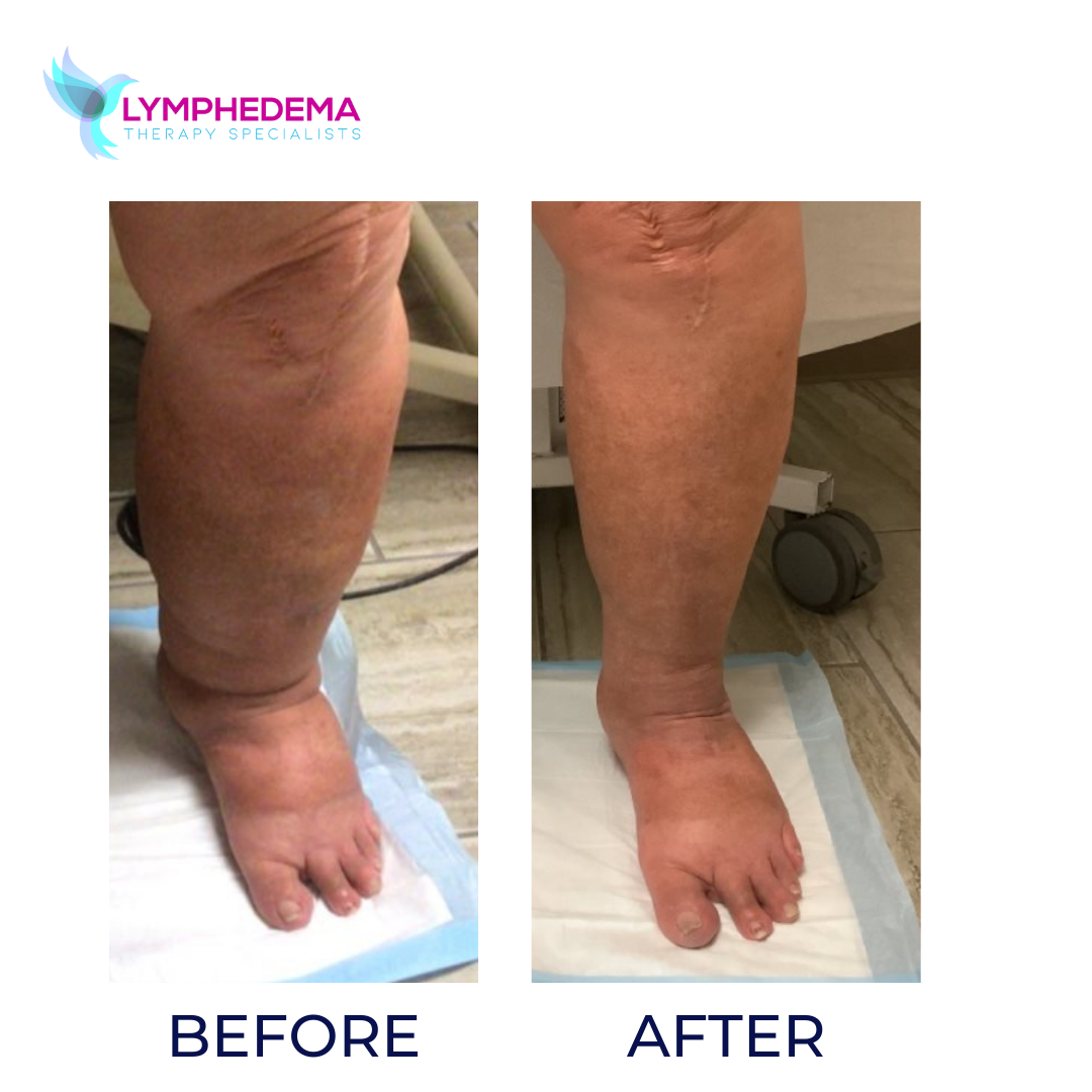 BEFORE AND AFTER LYMPHEDEMA TREATMENT