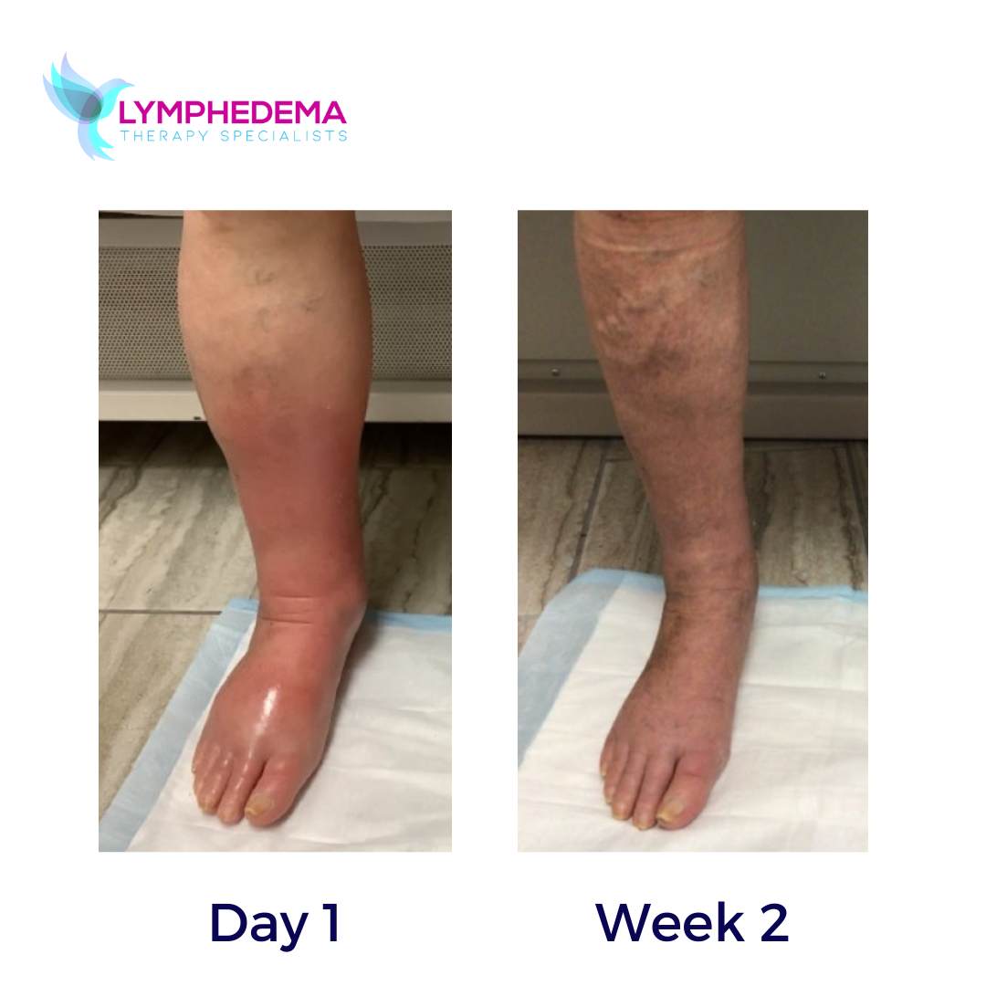 LYMPHEDEMA BEFORE AND AFTER (10)