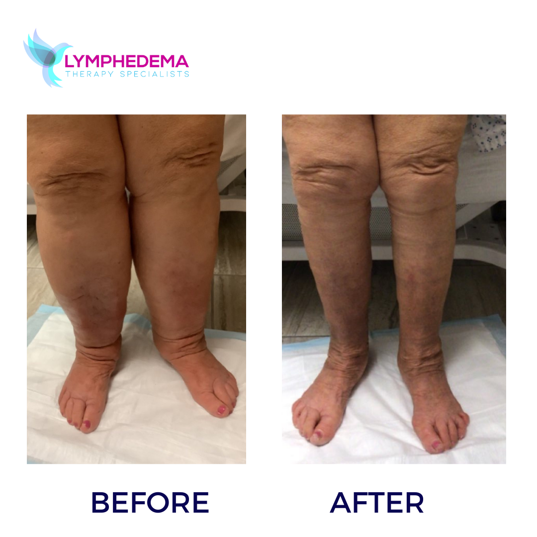 LYMPHEDEMA BEFORE AND AFTER (12)