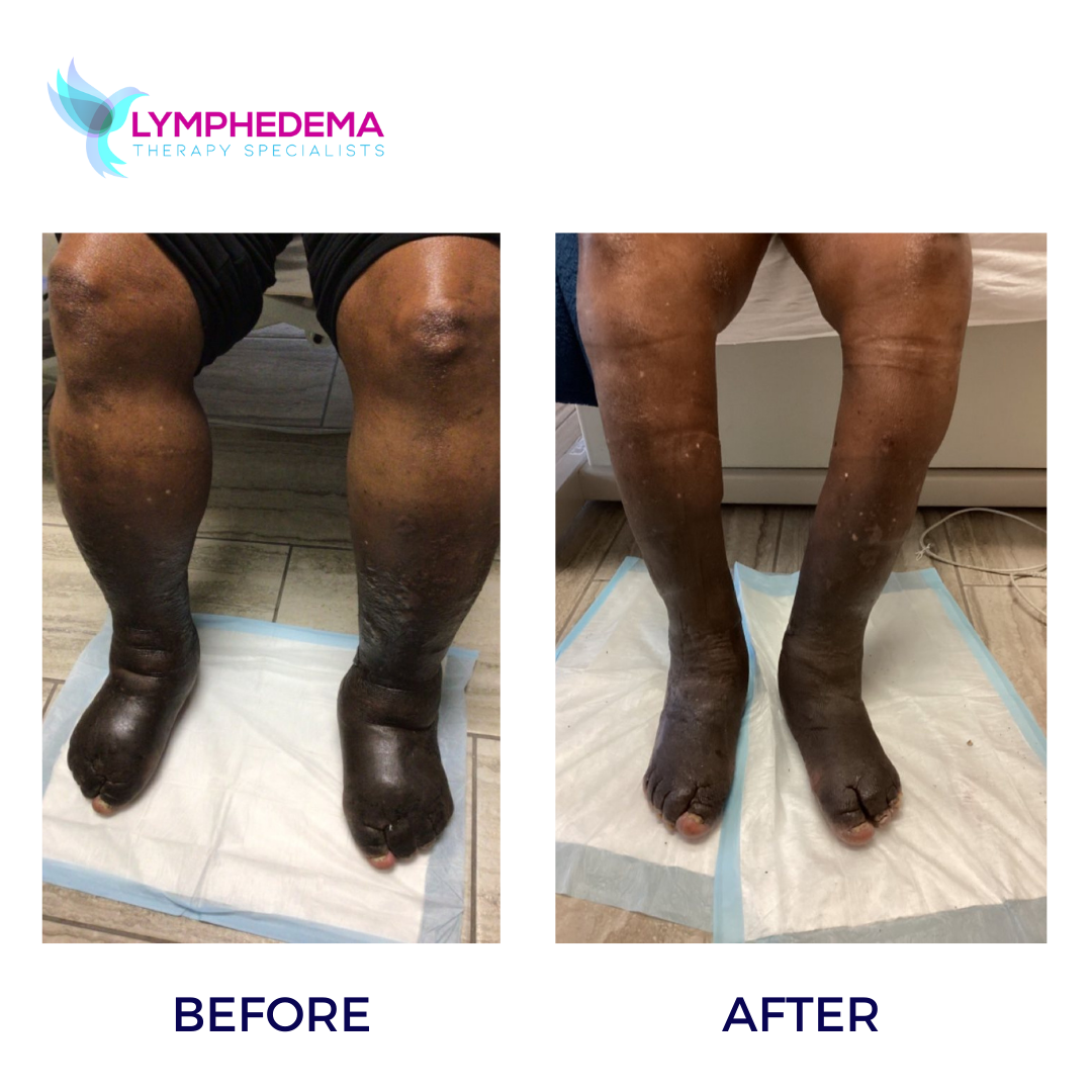 LYMPHEDEMA BEFORE AND AFTER (15)