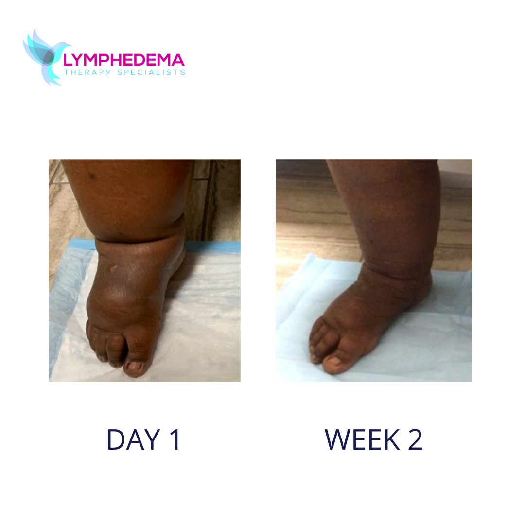 LYMPHEDEMA BEFORE AND AFTER (4)