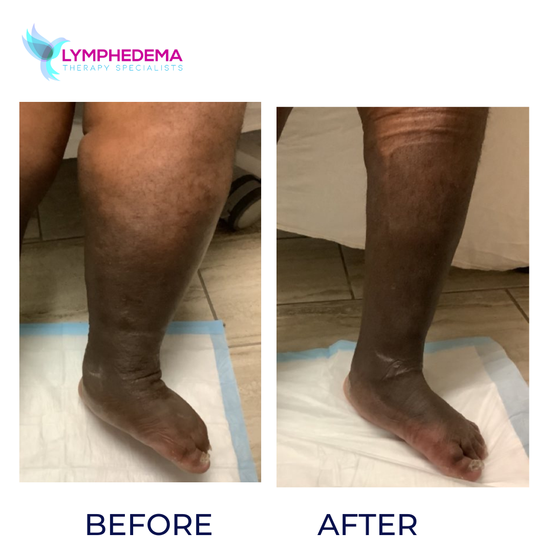 Lymphedema Therapy Houston Texas