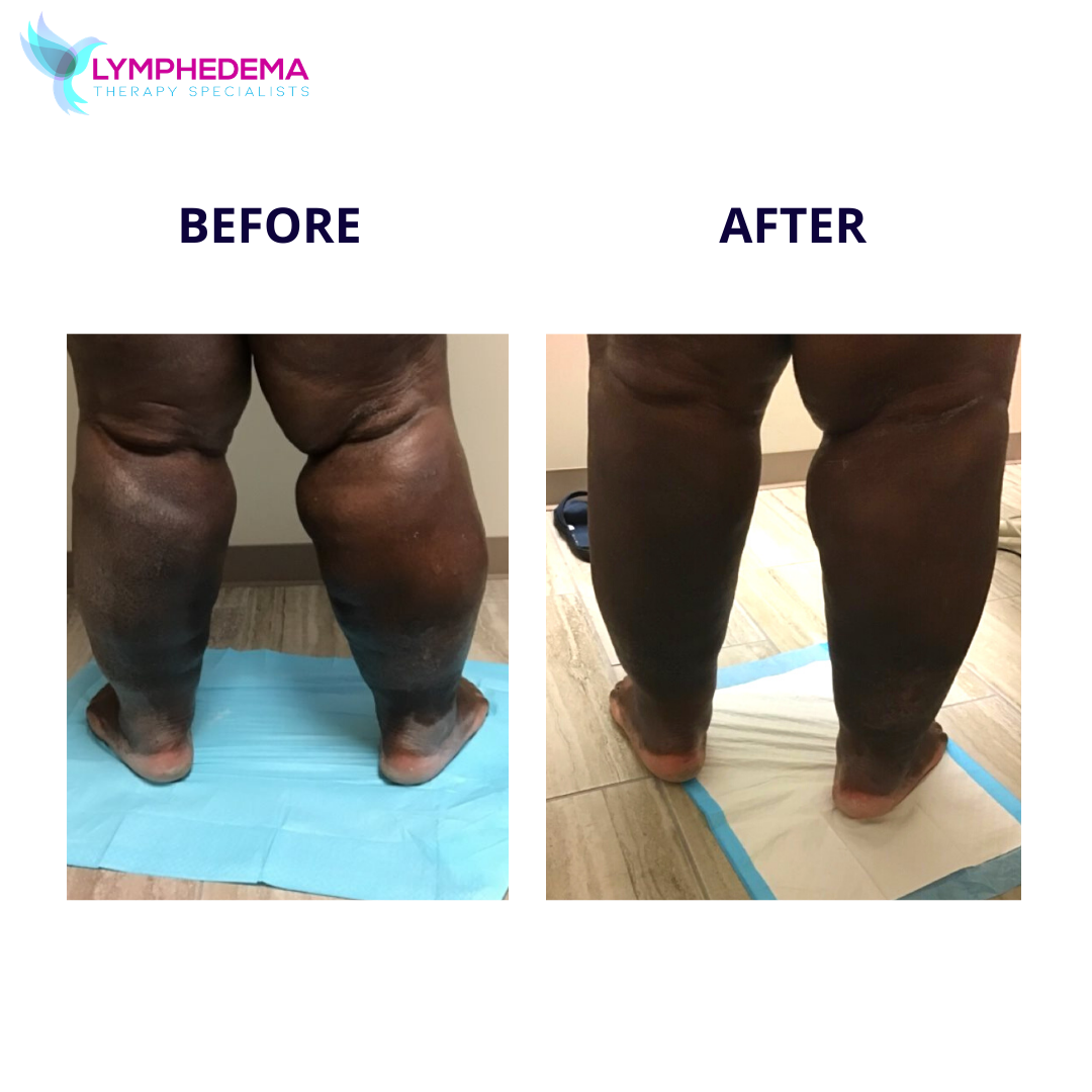 lymphedema therapy specialists (8)