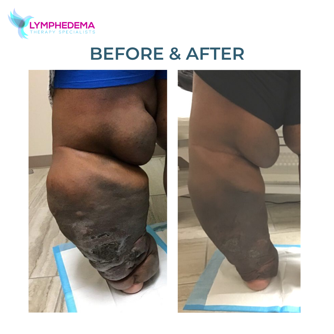 lymphedema treatment before and after