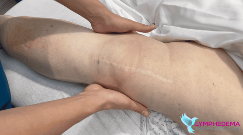 Manual Lymph Drainage, MLD